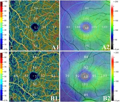 Is preclinical diabetic retinopathy in diabetic nephropathy individuals more severe?